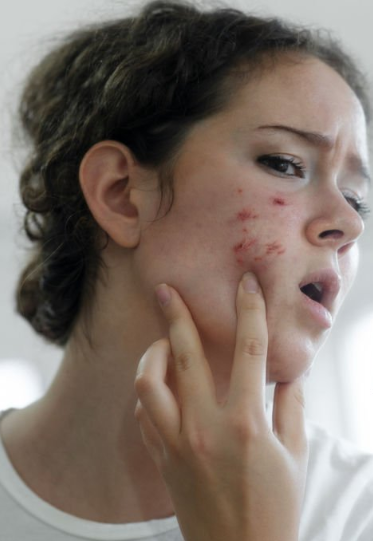 acne-causas-reales-y-soluciones-simples